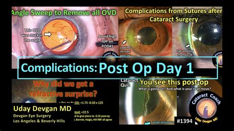 Cataractcoach 1394 Post Op Day One Complications After Cataract