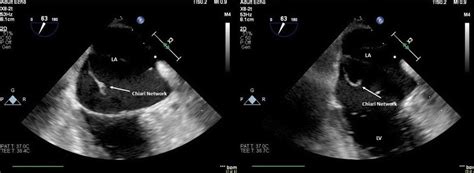 Chiari Network Or Catheter Associated Thrombus A Rare Complication Of