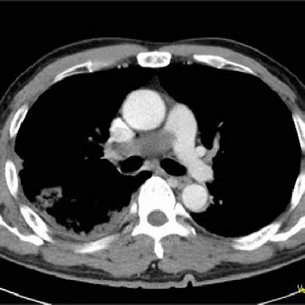 Macro Findings Of The Pulmonary Artery Show Sarcoma And Thrombus