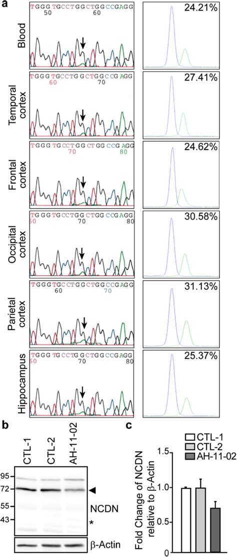 Detection Of The Ncdn De Novo Variant C G A P Trp In The