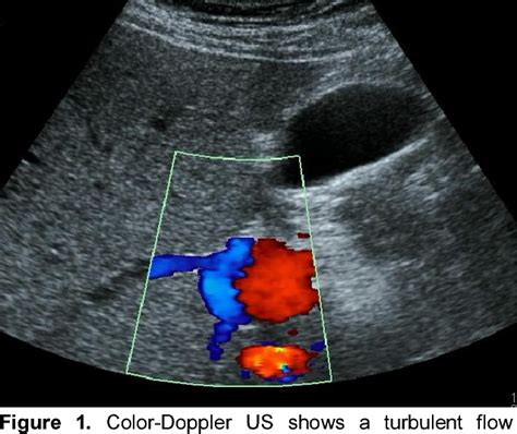 Figure From Intrahepatic Portal Vein Aneurysm In An Asymptomatic