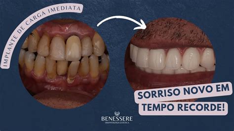 Periodontite Antes E Depois - Tratamento De Periodontite Antes E Depois Vale A Pena Abrir Um Retalho