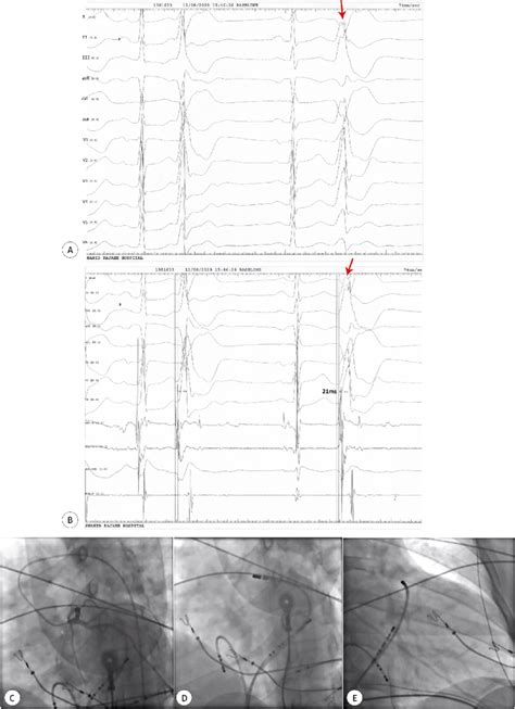 The Image Shows The Successful Ablation Of An Lvs Pvc From The Lv