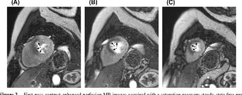 Figure 4 From Cardiac Mri In Ischemic Heart Disease Semantic Scholar