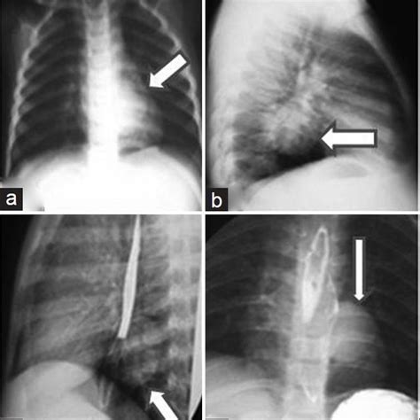 A And B Chest X Ray Showing Mediastinal Mass A PA View