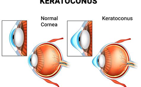 Keratoconus Cone Shaped Cornea The Eyes2eyes Foundation