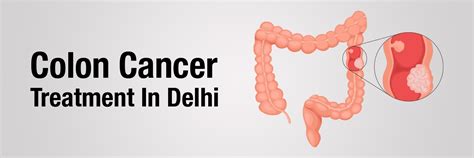 Effective Colon Cancer Treatment in Delhi | Dr Asit Arora