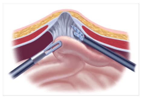 Hernias Ventrales Alayon Surgical