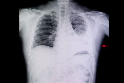 A Chest Xray Of A Patient With Rib Fractures And Pleural Effusion