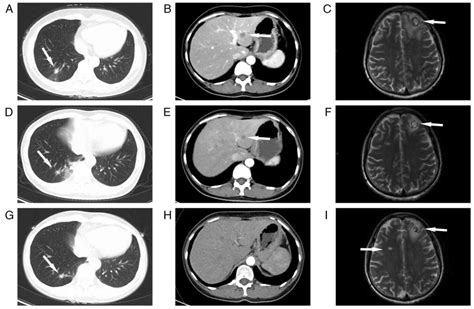 Primary Lung Adenocarcinoma With Breast Metastasis Harboring The Eml4‑alk Fusion A Case Report