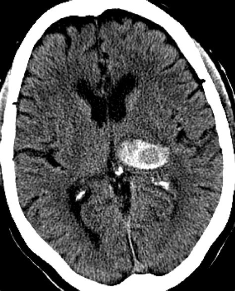 Cerebral Amyloid Angiopathy Mri