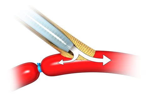 Illustration Vascular Prosthesis Medicalgraphics