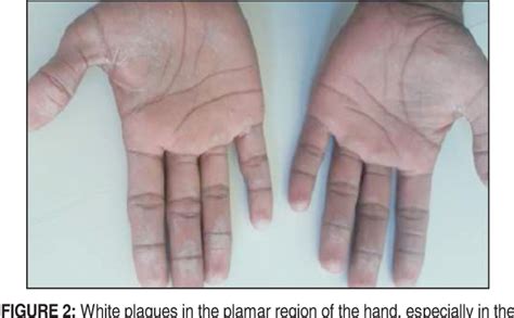 Two Cases With Aquagenic Palmoplantar Keratoderma Semantic Scholar