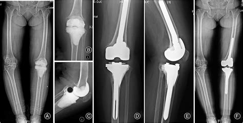 Reconstruction For Massive Proximal Tibial Bone Defects Using Patient