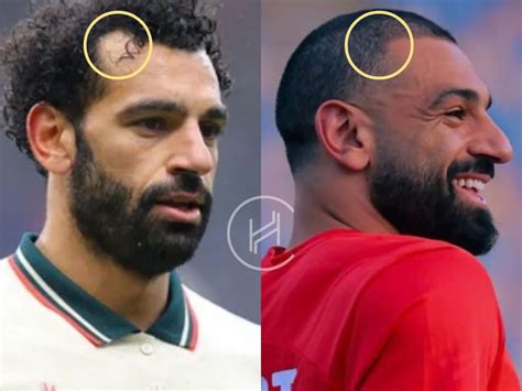 Mo Salah Hair Transplant Hair Loss Technical Analysis