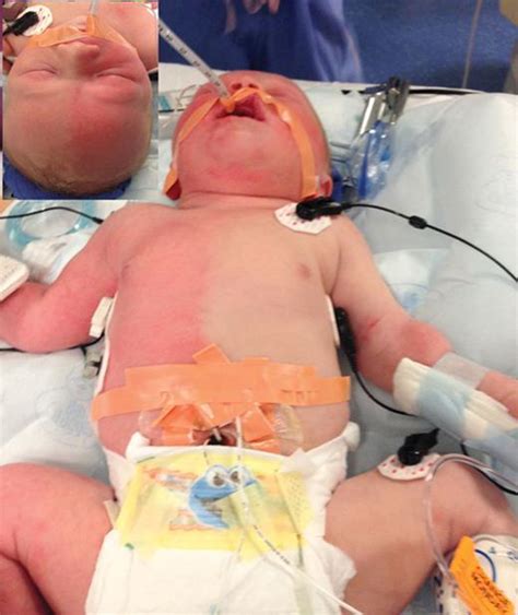 Harlequin Phenomenon In A Newborn After Induction Of General Anesthesia Anesthesiology