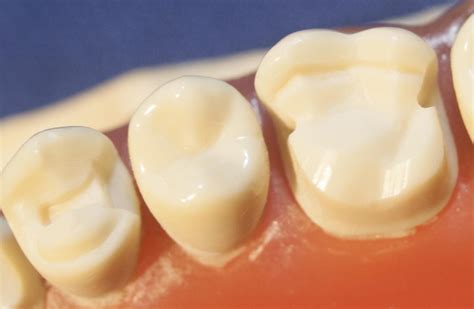 Dental Gold Onlays And Crowns Posterior Teeth V6 The Center For