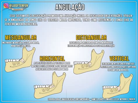 Classifica O De Dentes Impactados Cirurgia