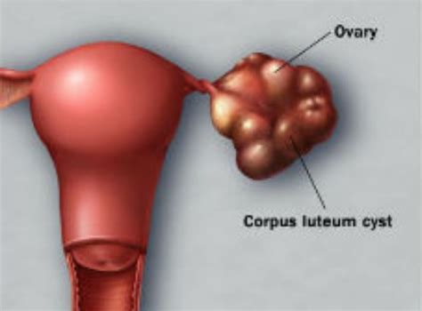 Comment Traiter Les Kystes Ovariens D Couvrez Les Astuces Naturelles