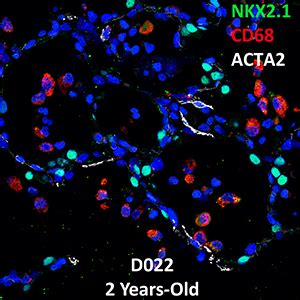 Year Old Human Lung Confocal Imaging Donor D Nkx Cd And Acta