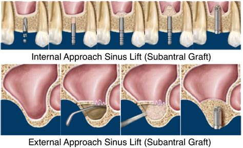 Sinus Lift Subantral Graft Pacific Oral Surgery