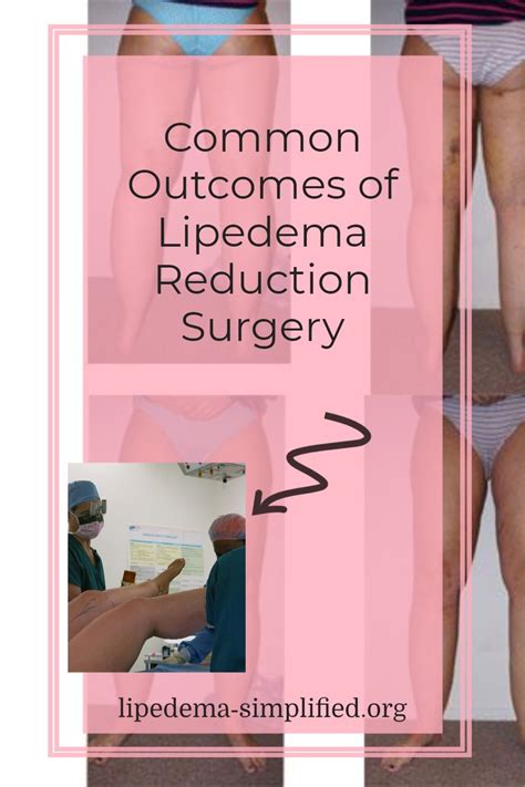 Connection Between Lipedema Obesity Lymphedema Artofit