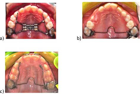 Fig 1 Intraoral Photographs Of The RME A And Conventional TPA