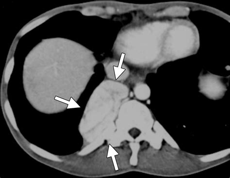 Castleman Disease The Great Mimic Radiographics