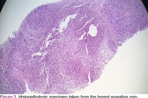 Figure From Granulomatous Mastitis As A Presentation Of Sarcoidosis