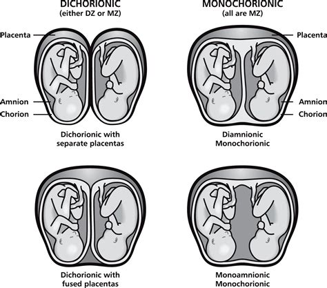 Gemeos De Placenta Diferentes - Gemeos Em Placentas Diferentes - NAZAEDU