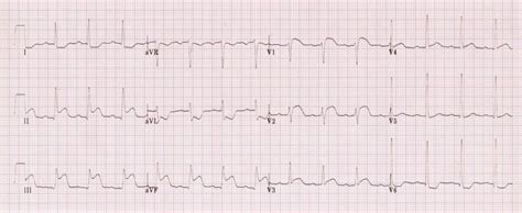 ECG Case 001 • LITFL • ECG Top 100 Self-Assessment Quiz