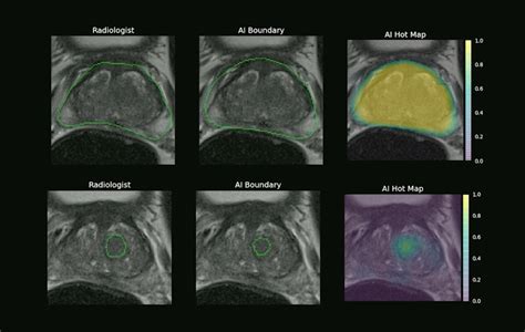 Ezra Delivers Full Body Mri Cancer Screening That Saves Lives — Ldv Capital