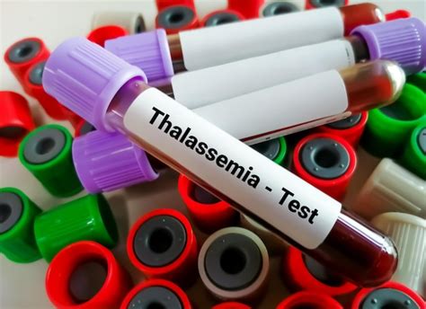 Amostra De Sangue Para Teste De Talassemia Foto Premium