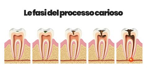 Le Carie Dentali Cosa Sono Come Curarle E Come Prevenirle