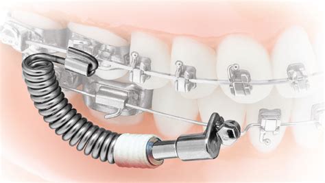 Vektorpro Class Ii Corrector Tp Orthodontics