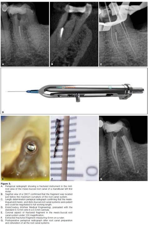 Fracture Of Endodontic Instruments Part Literature Review On