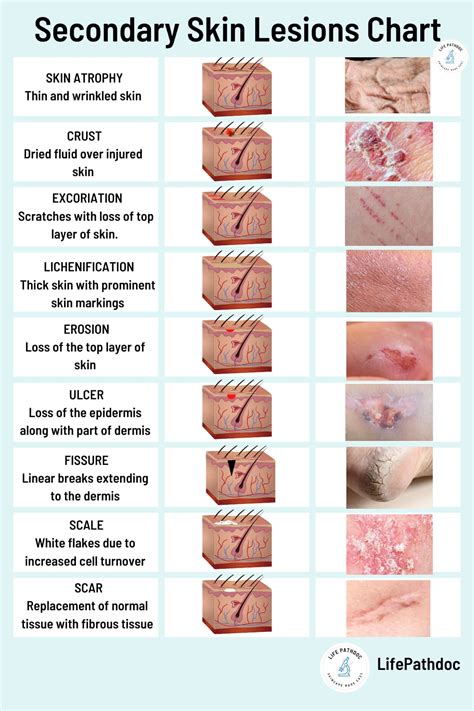 Skin Lesions Primary And Secondary Skin Lesions Dermatology Basics