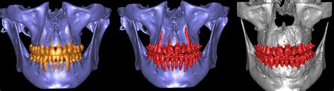 Orthodontic Digital Planning Dr Mandelaris And Dr Degroot