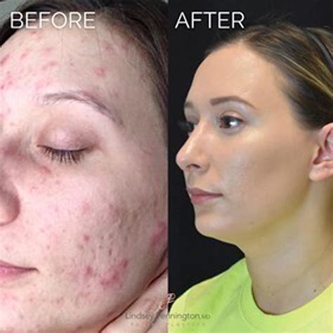 Microneedling With PRP Before And After Gallery Pennington