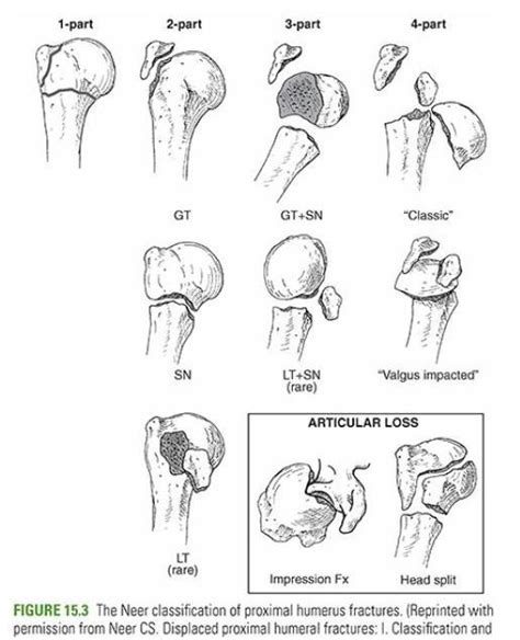 NEER PROXIMAL HUMERUS FRACTURE CLASSIFICATION - RayOrthos