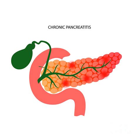 Chronic Pancreatitis 1 By Pikovit Science Photo Library