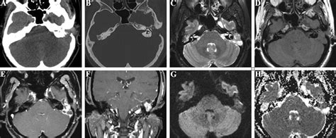 Squamous Cell Carcinoma In A 57 Year Old Man Axial Ct Soft Tissue