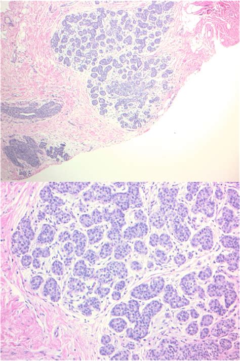 Lobular Neoplasia Surgical Clinics