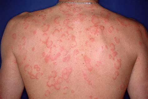 Mastocytosis Rash