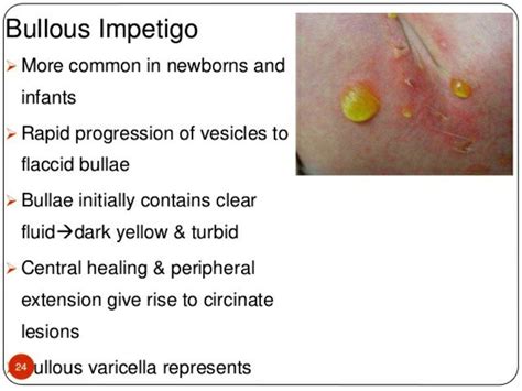 Bullous Impetigo Children