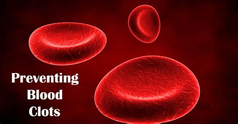 Preventing Blood Clots A Lifesaving Guide Mdt Home Health Care Agency