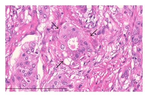 Morphologic Findings Hematoxylin And Eosin Stain A Tumor Cells Download Scientific Diagram