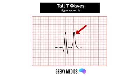 How to read an ECG | ECG Interpretation | Geeky Medics