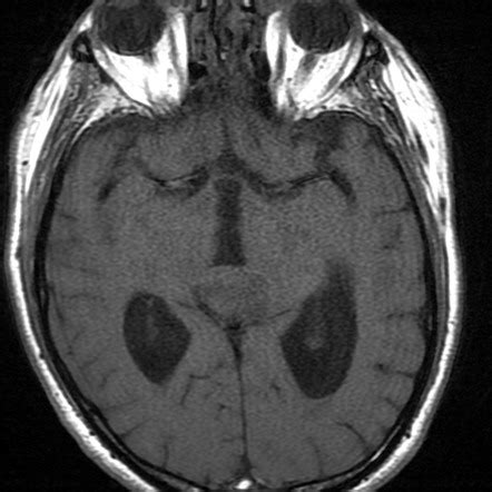 Pineoblastoma | Image | Radiopaedia.org