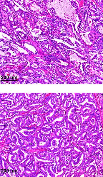 New findings on the diagnosis of liver tumors Charité